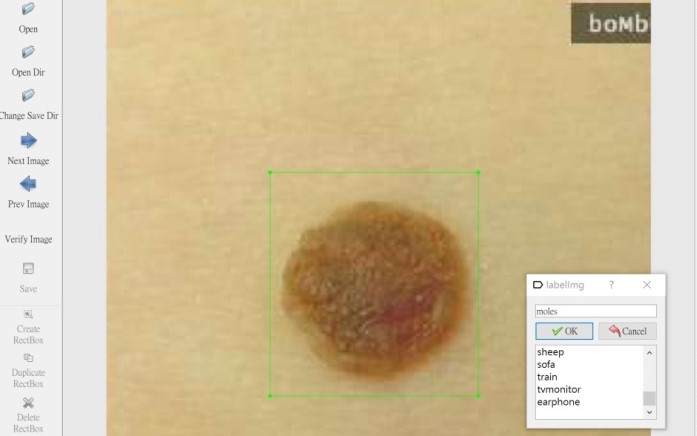 AI Vision for Skin Tumor